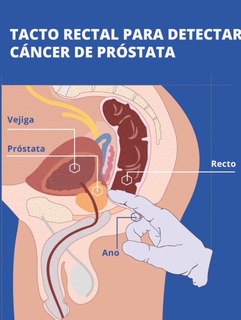 cancer prostata5